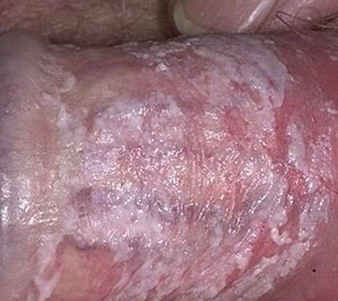 écoulement coagulé lorsqu'il est excité