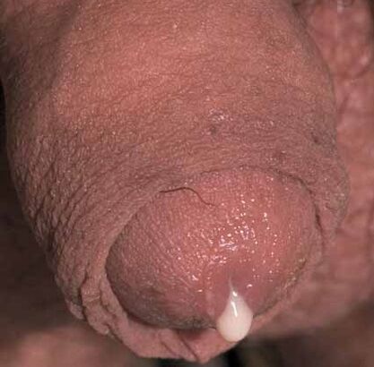 écoulement pathologique lorsqu'il est excité