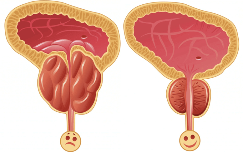 Causes des problèmes de puissance chez les hommes